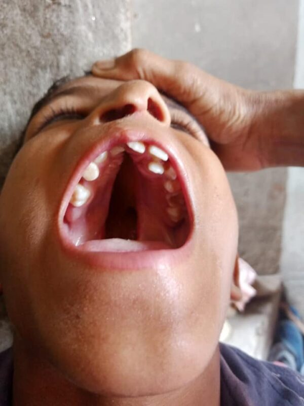 Free Surgery Camp for Cleft Lip and Cleft Palate
