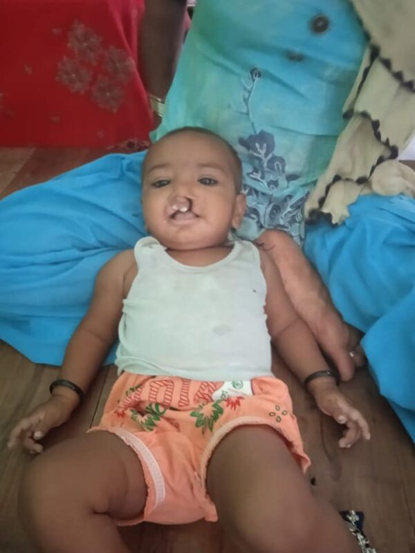 Free Surgery Camp for Cleft Lip and Cleft Palate