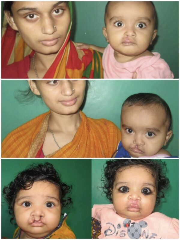 Free Surgery Camp for Cleft Lip and Cleft Palate