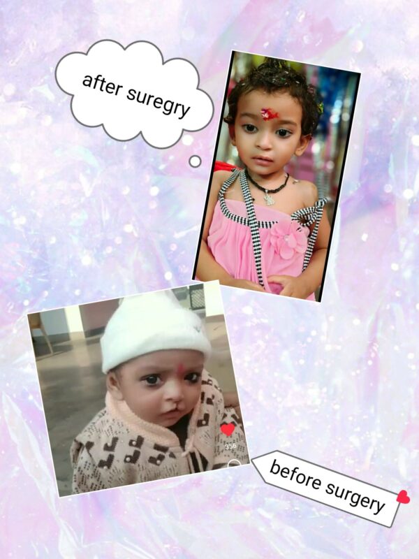 Free Surgery Camp for Cleft Lip and Cleft Palate